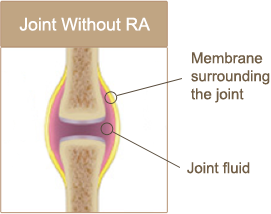 Joint without RA